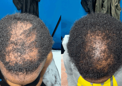Before and after comparison showing restored hairline and improved hair volume from Procell Hair Restoration