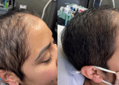 Transformation photo showing stronger, fuller hair after Procell Hair Restoration at Rejuv Head Spa