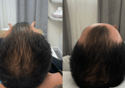 Visible results of Procell Hair Restoration: thinning scalp before and thicker hair growth after