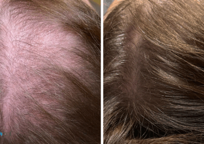 Comparison of thinning hair before and fuller, healthier hair after Procell Hair Restoration treatment