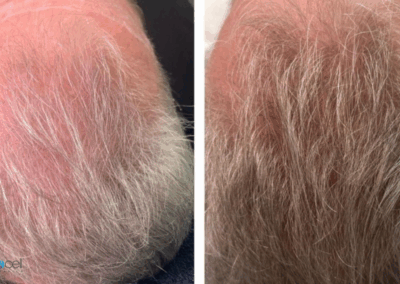 Before and after photo showing visible hair regrowth from Procell Hair Restoration at Rejuv Head Spa