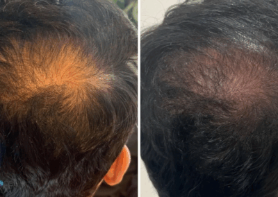 Side-by-side image highlighting improved hair density after Procell Hair Restoration sessions